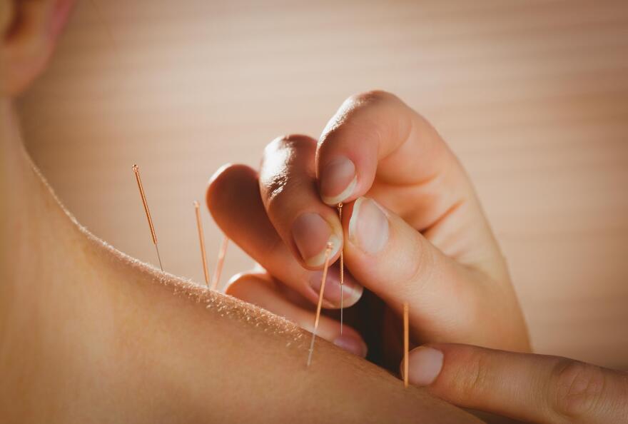 Acupuncturists place needles in various points throughout the body. (Image: Shutterstock / wavebreakmedia)