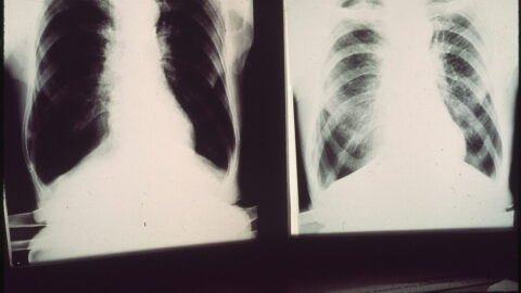 X-rays of a patient with black lung disease.