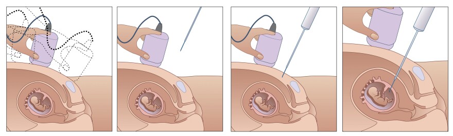 During amniocentesis, a needle is inserted through a woman's abdomen into the amniotic sac. A sample of fluid is extracted and screened for genetic disorders such as Down syndrome.