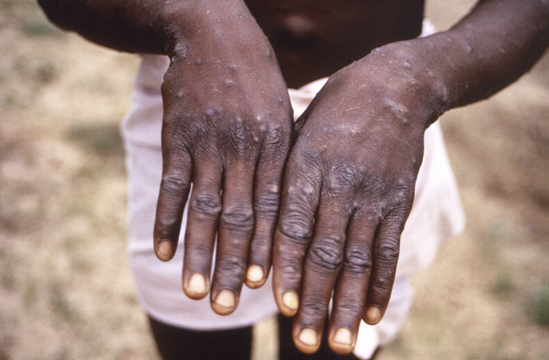 This 1997 image provided by the CDC during an investigation into an outbreak of monkeypox, which took place in the Democratic Republic of the Congo (DRC), formerly Zaire, depicts the dorsal surfaces of the hands of a monkeypox case patient.