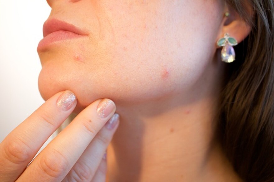 Pimples can appear anywhere on the body.