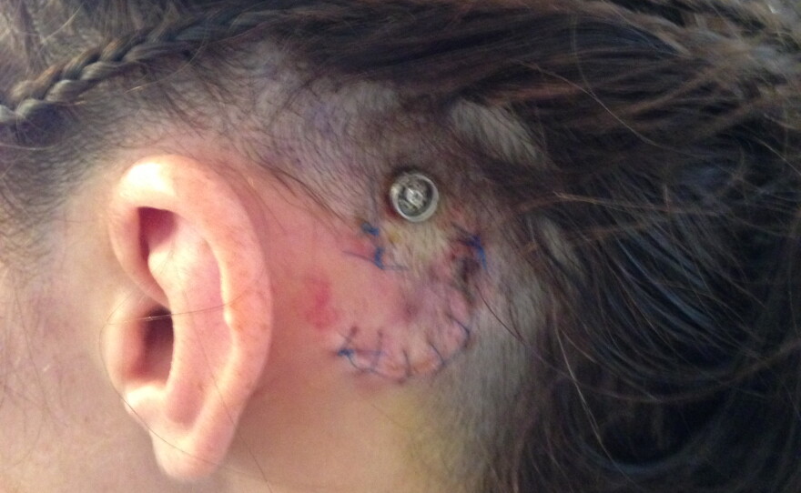 Tiffany Storrs shows her surgical scars after her cochlear implant surgery.