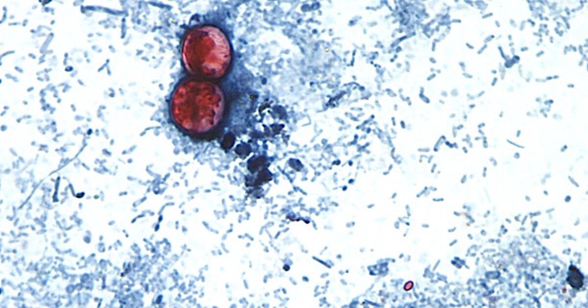 Alachua and Columbia Counties report cases of cyclosporiasis