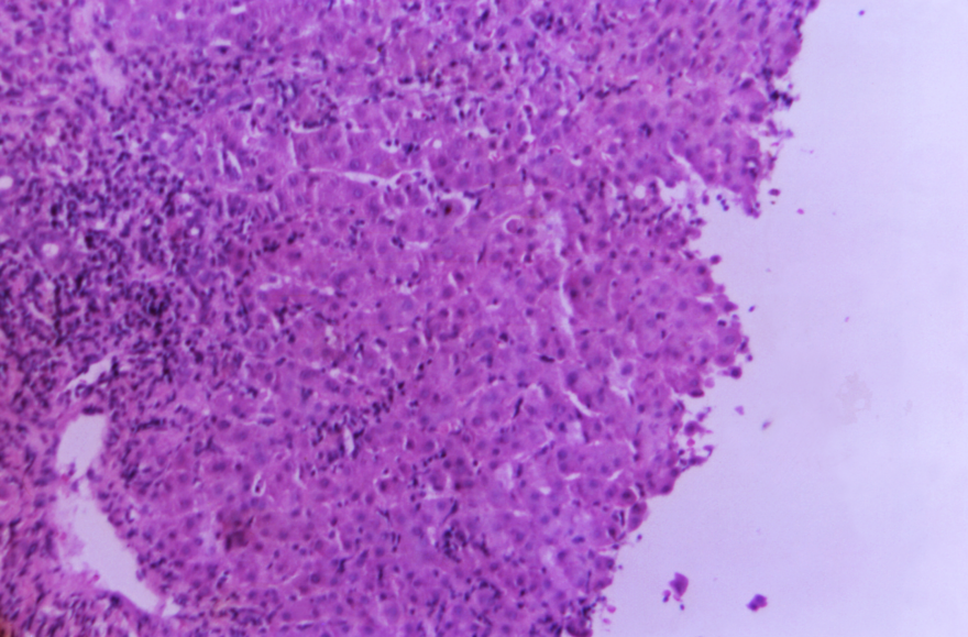 A photomicrograph of a liver biopsy tissue specimen with active acute viral hepatitis.