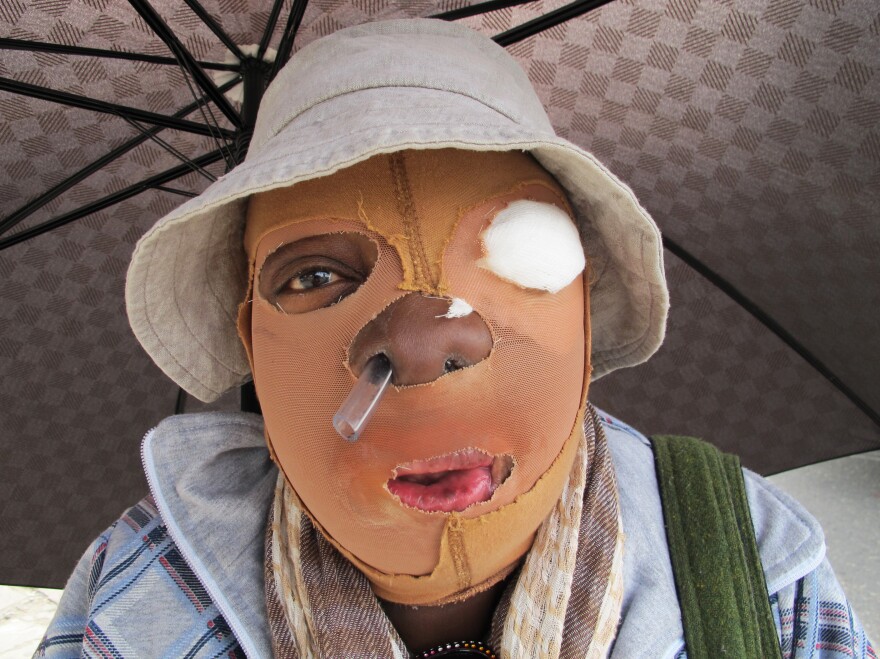 Consuelo Cordoba's partner threw acid at her a decade ago. The 51-year-old Colombian has undergone multiple surgeries and is unable to find work. This year, about 100 cases of acid attacks — mostly against women — have already been reported in Colombia.
