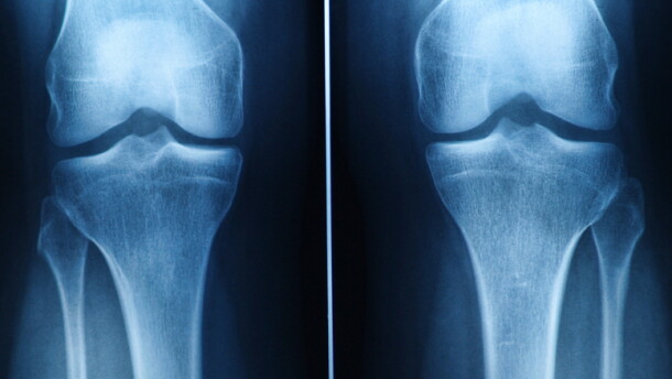 Knee pain is common, but surgery isn't necessarily the answer, researchers say.