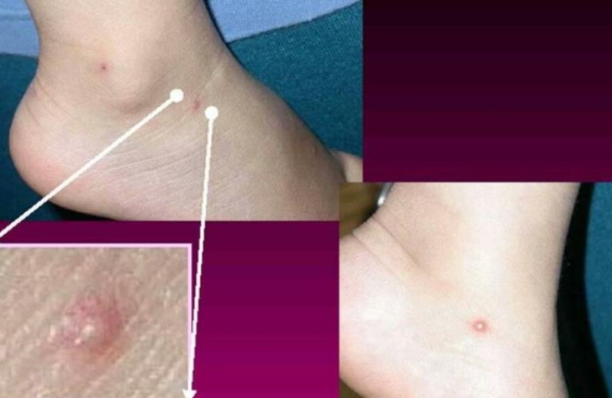 The second pediatric case of hMPXV, or monkeypox, has been confirmed in Oregon. The first case in a youth under 18 was identified in August, 2022.