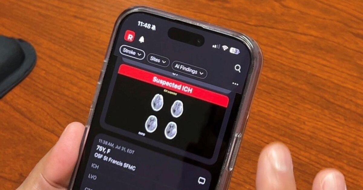 OSF expands AI use to assess strokes