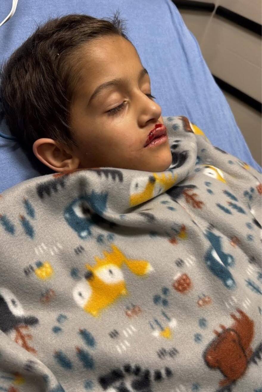 Adriana Edgerton posted a photo of her son, 7-year-old Alezander, in the hospital before his heart surgery. She said the impact of the drone left an imprint in Alezander's chest.