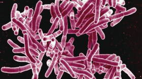 Tuberculosis is spread through the air.