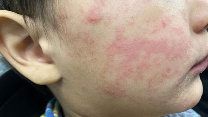 Characteristic rash associated with measles.