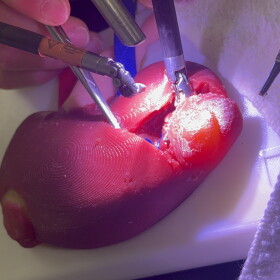 In this file photo, a Lazarus 3D kidney analog is used for a surgery rehearsal.
