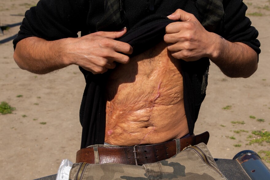 Hatem al-Hamad, 28, from Aleppo, Syria, and staying in Serbia's Krnjaca asylum center, shows his scars. He says the main injury came from a bomb blast in the Syrian war. Additional scars are from surgery he underwent in Belgrade in February. He says Hungarian police assaulted him on the country's border with Croatia. Hungarian officials have denied allegations of abuse.
