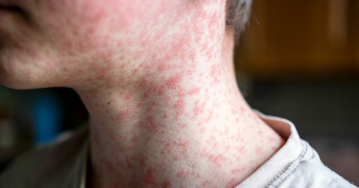 Utah leads nation in measles cases, no new Wasatch Back cases