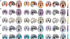 MRI slice overlays displaying biomarker differences between each MT group and males. (Credit: "Menopause impacts human brain structure, connectivity, energy metabolism, and amyloid-beta deposition" /Sci Rep. 2021) 