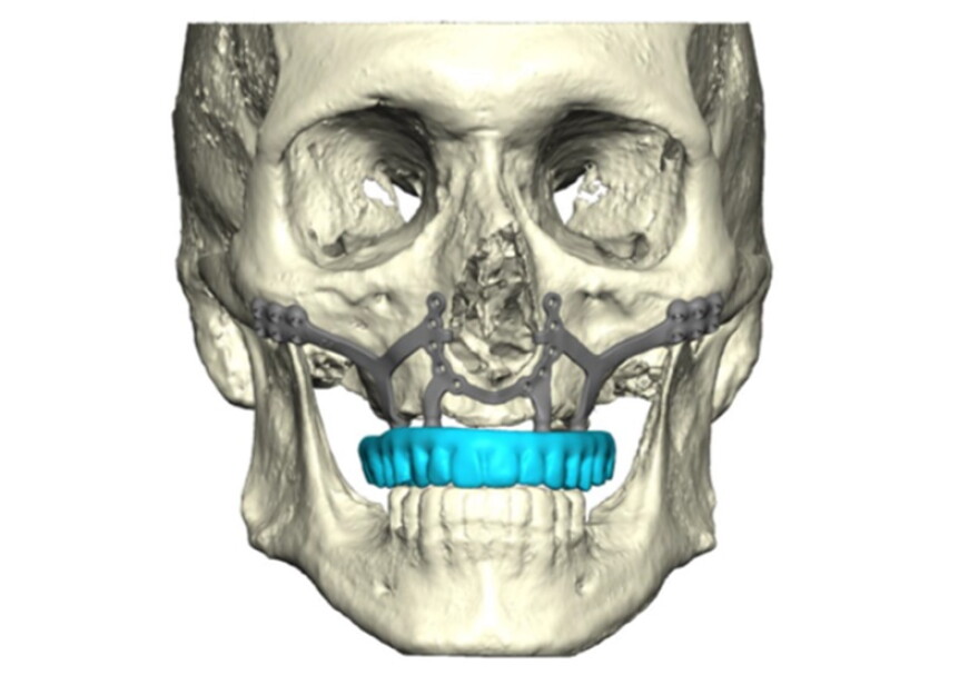 Lexington VA Healthcare staff are among the first in the United States to offer a new type of surgery for people with bone loss so severe they can't wear dentures.