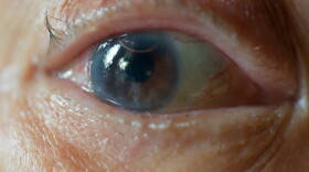 Old man's eye with trace of cornea surgical operation and air bubble