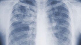 Chest x-ray photo showing ribs