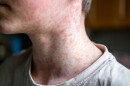 This stock image shows a person with measles.