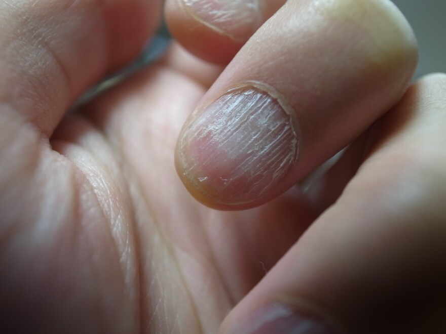 Dry hair, skin, and nails could point to underlying health problems | WRVO Public Media Dry hair, skin, and nails could point to underlying health problems | WRVO Public Media