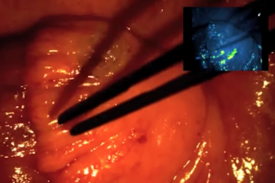 In the right hand corner, under fluorescent lamp, the cancerous tissue glows.