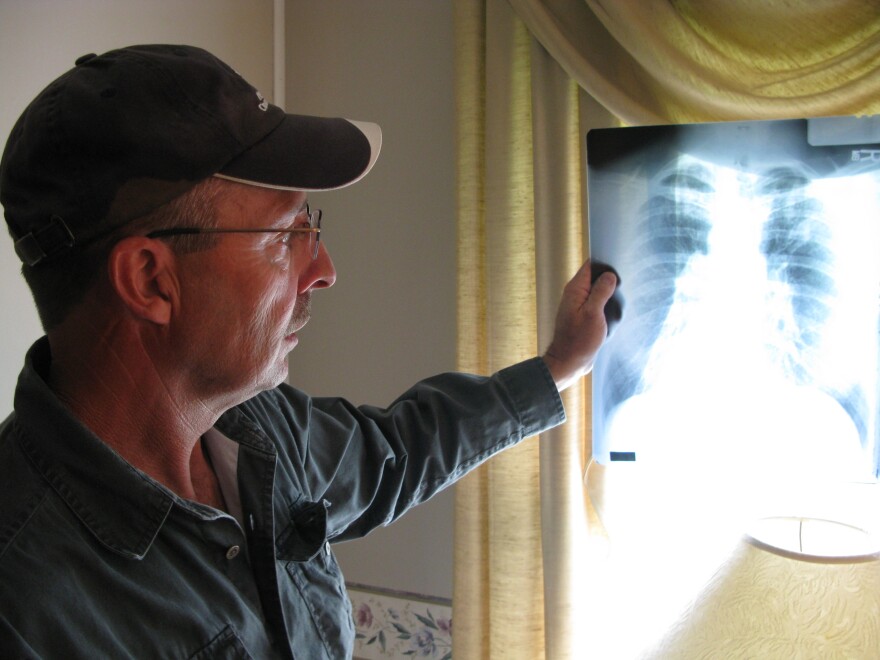 Retired coal miner Mark McCowan reviews an X-ray of his diseased lungs at his home in Pounding Mill, Va. McCowan has progressive massive fibrosis, the worst stage of black lung disease.