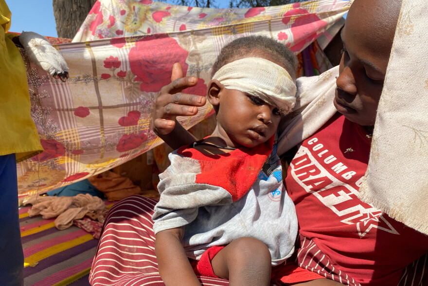 FILE - A Sudanese child, who fled el-Fasher city with family after Sudan's paramilitary forces attacked the western Darfur region, receives treatment at a camp in Tawila, Sudan, Nov. 2, 2025. (AP Photo/Mohammed Abaker, File)