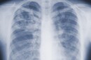 Chest x-ray photo showing ribs