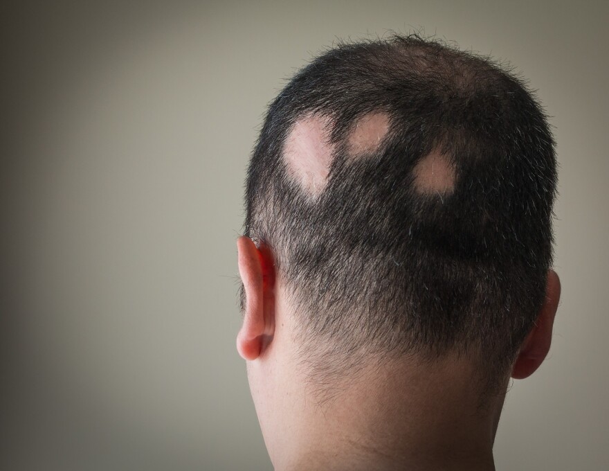 Example of Alopecia