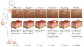 Mpox stages