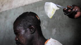 A man with machete wounds to his head from an attack by rebels of the Lord's Resistance Army (LRA) is treated in a hospital on February 21, 2009 in Ngilima, northeastern Congo. 