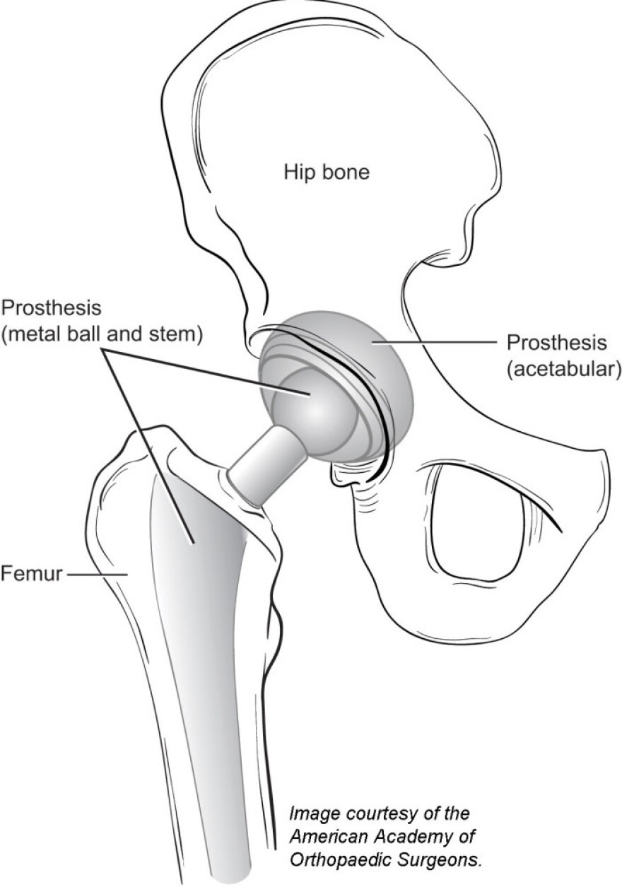 A diagram of a total hip replacement.