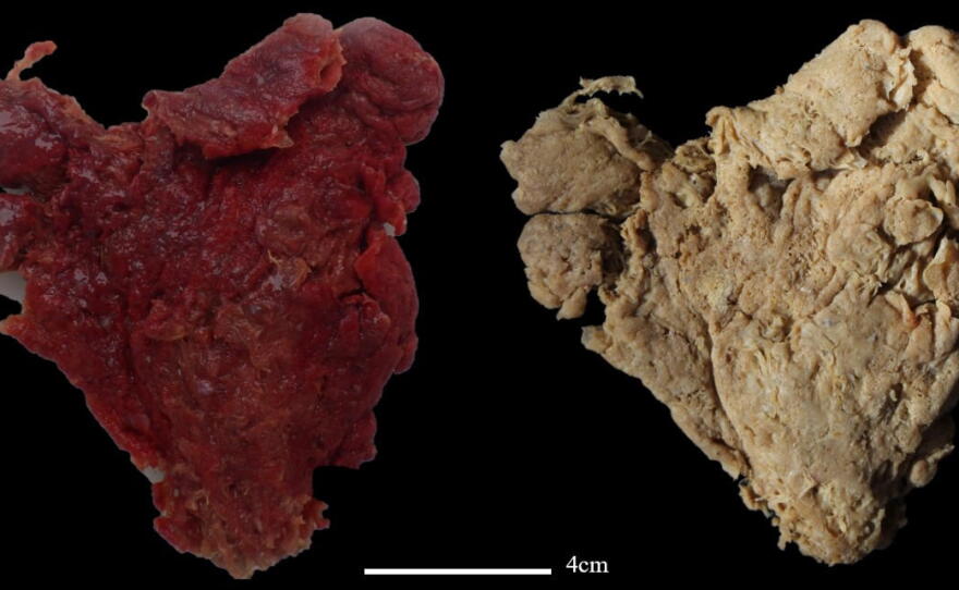 Polycapus rubrum, a vibrant red, thickly layered sponge and one of the new sponge species discovered. Its combination of acanthoxeas and chelae spicules do not occur in any other genus in the family Hymedesmiidae, which necessitated creating a new genus for this species called Polycapus.