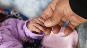 A nurse checks a child who is receiving treatment for malnutrition this month at a hospital in Sanaa, Yemen. <strong></strong>
