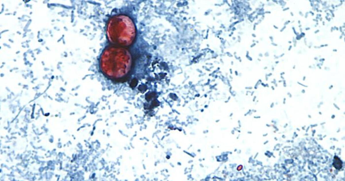 Oklahoma cyclosporiasis cases climb past 500 in latest health department update