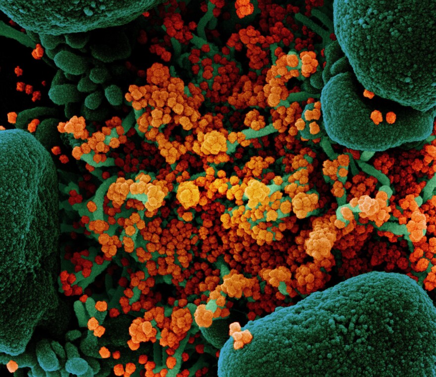 A colorized scanning electron micrograph of a cell (green) heavily infected with particles (orange) from the virus that causes COVID-19, isolated from a patient sample.