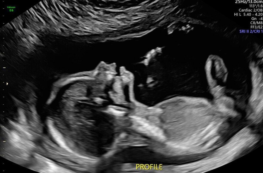 An 18 week, six day infant ultrasound image of the child of Tim and Emily Jagielo.