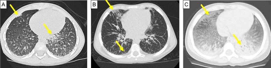 Some systemic JIA patients develop inflammation in the lung. Surfactin, the body's lubricant, doesn't clear out.