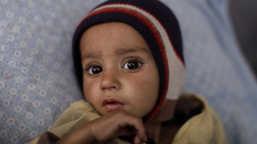 Eid Mohammed who suffers from from chronic malnutrition, lies on a bed at Indira Gandhi Children's Hospital, in Kabul, Afghanistan in 2011. In 2001, one of every four children born in Afghanistan died by the age of five. Today, one in 10 children dies by age 5.