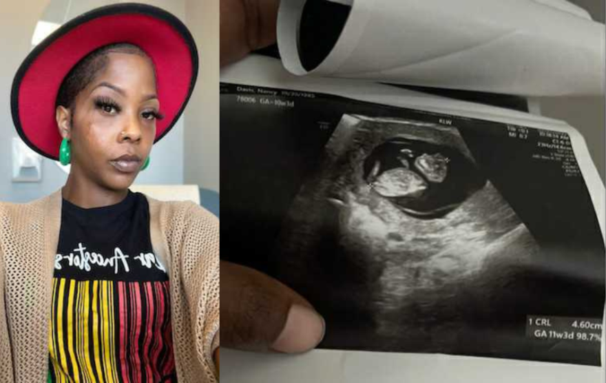 Nancy Davis, 36, left, and an ultrasound image showing her baby, who was diagnosed with acrania.