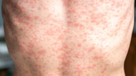 This stock image shows a person's torso covered in a measles rash.