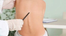 Adolescent idiopathic scoliosis occurs in boys and girls, but progressive cases are far more common in girls.
