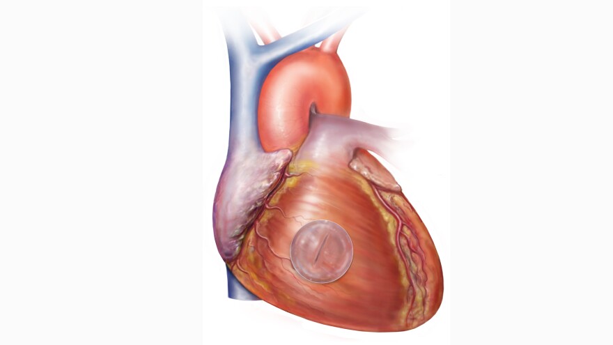 The superglue developed by scientists sticks to wet, bloody surfaces. Researchers hope the adhesive could one day seal a torn vessels or fix heart defects.