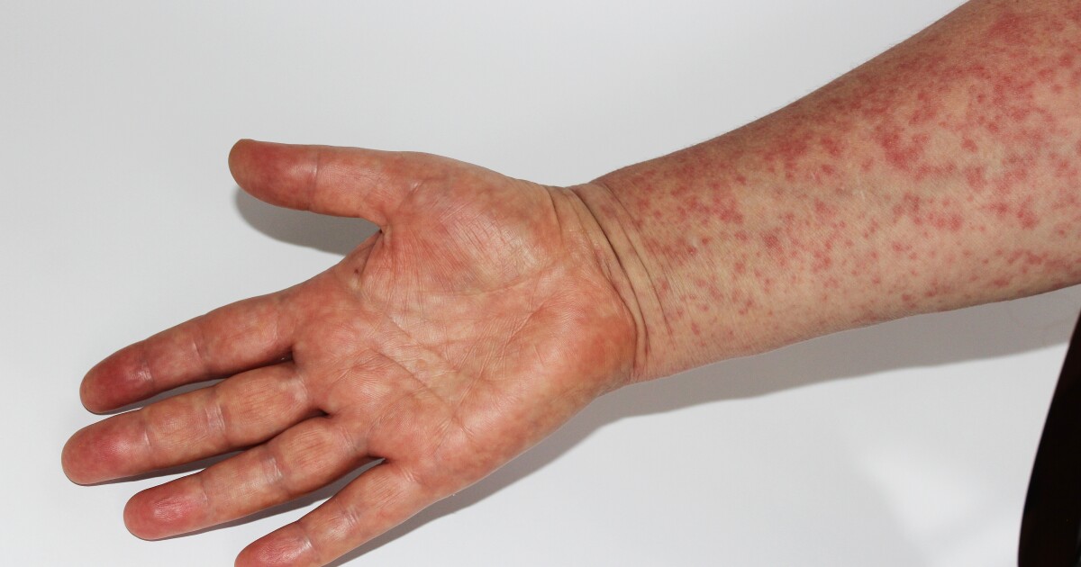 North Texas public health officials prepare for possible measles spread North Texas public health officials prepare for possible measles spread