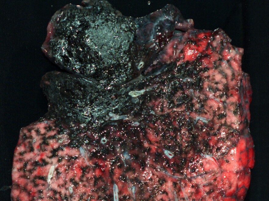 Severe black lung disease deeply scarred the lung of a 61-year-old West Virginia coal miner, which was removed as part of a lung transplant.