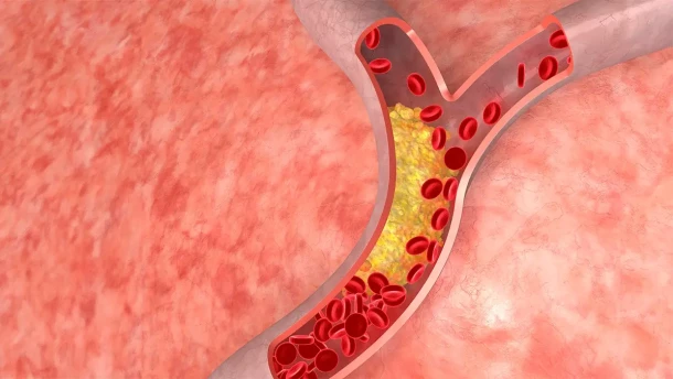 New Cleveland Clinic research shows the potential of gene therapy to cut cholesterol levels in half in one treatment.