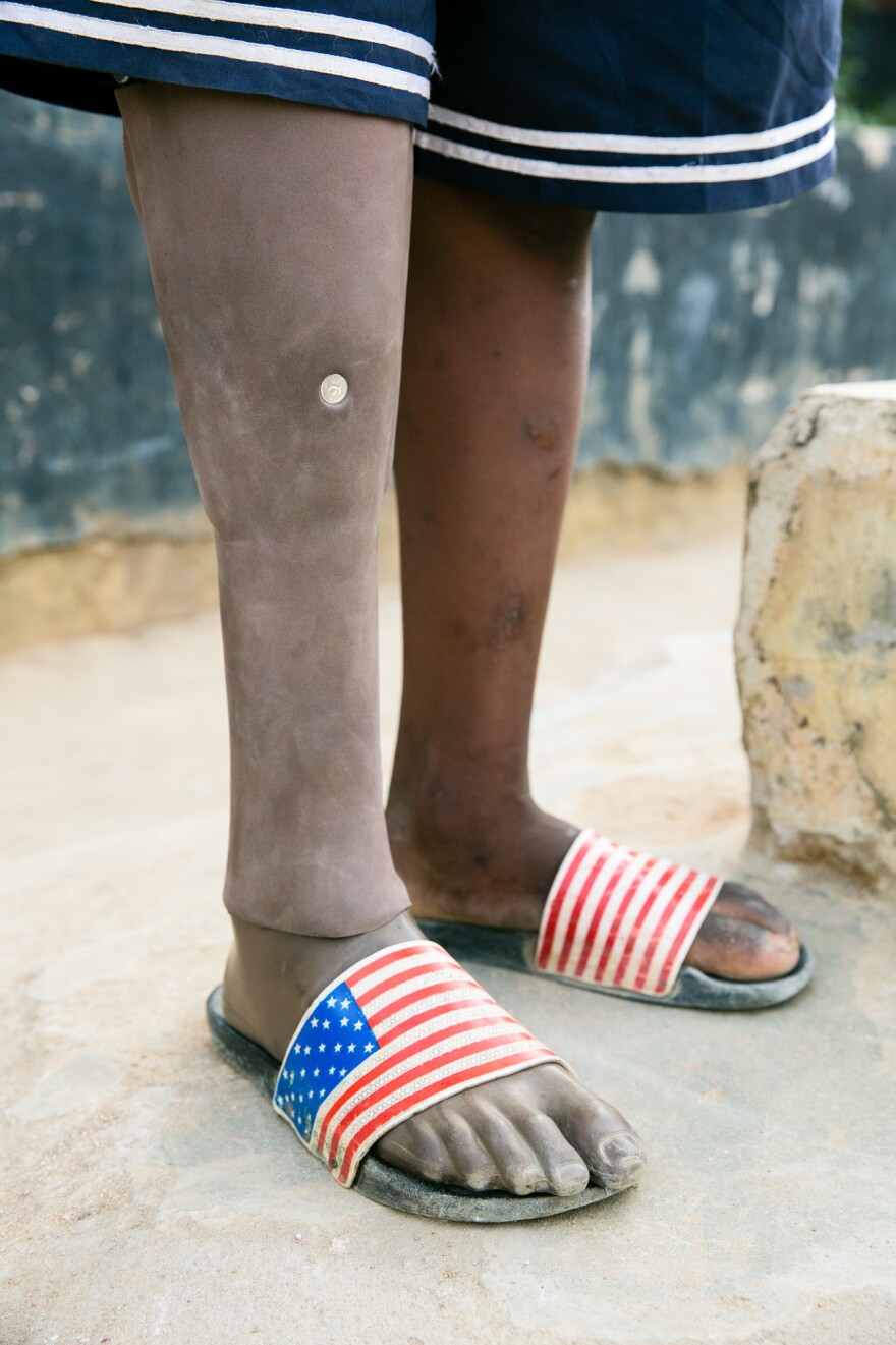 Sundaygar's prosthetic right leg looks so realistic that some kids at the orphanage think it's real.