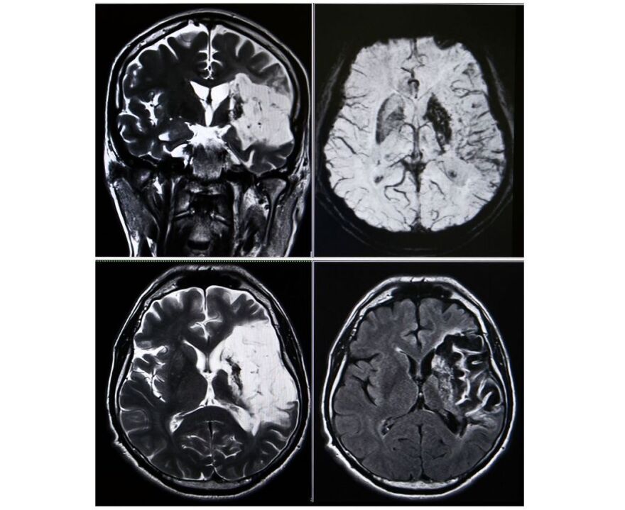  images of brain scans indicating stroke