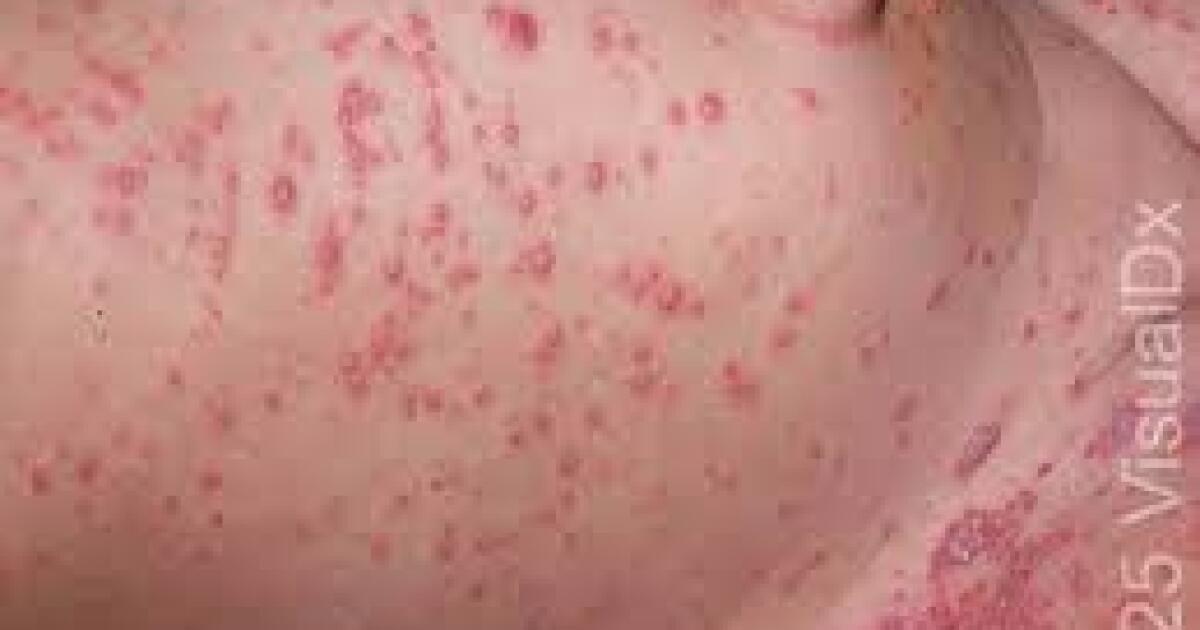 Marquette County Health Department urging vaccinations amid chickenpox case