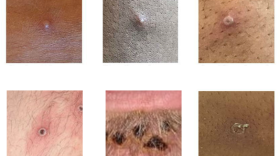 The monkeypox virus causes lesions that can resemble sores from acne, an ingrown hair or other viruses. They are infectious until the scab is fully healed. (UK Health Security Agency/CDC)